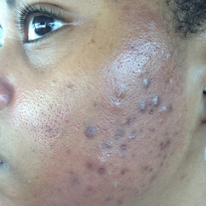 Close-up of a person's cheek showing severe acne with bumpy papules, pustules, and hyperpigmentation.