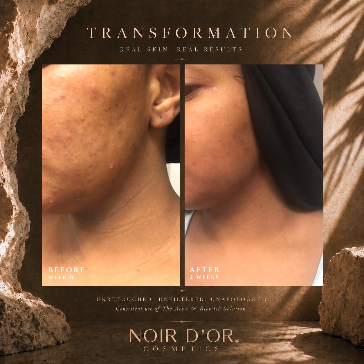 Acne And Blemish Solution - Large