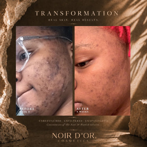 Acne And Blemish Solution - Enhanced