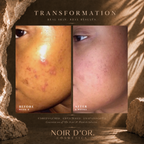 Acne And Blemish Solution - Large