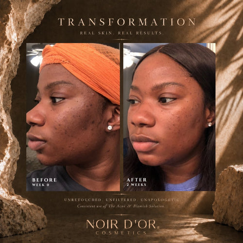 Acne And Blemish Solution - Small
