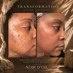 Acne And Blemish Solution - Enhanced